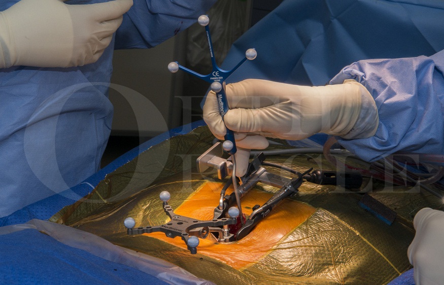 Spinal Fusion Surgery